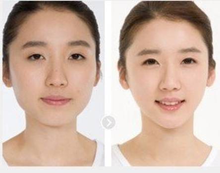 四惠哪家瘦脸安全无痛效果好都会国际3D瘦脸提升好 第1张