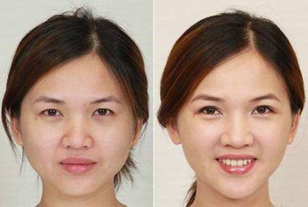 北京哪里专业瘦脸效果好十里堡3D瘦脸提升多少钱 第1张